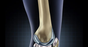 NPPA extends ceiling prices of knee implants till 14 September 2021 knee Implants