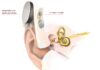 Surgeries with a totally implantable cochlear implant cochlear implant