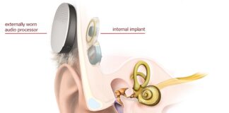Surgeries with a totally implantable cochlear implant cochlear implant