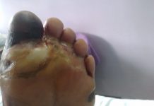 Alkem to launch state-of-art technology for Diabetic Foot Ulcer Alkem