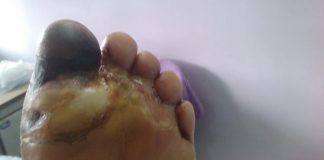 Alkem to launch state-of-art technology for Diabetic Foot Ulcer Alkem