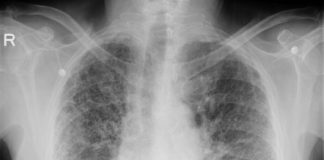 MannKind extends collaboration with Thirona Bio Mannkind