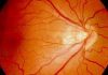 Early Retinopathy diagnosis can save 5,000 babies from going blind every year Retinopathy