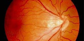 Early Retinopathy diagnosis can save 5,000 babies from going blind every year Retinopathy