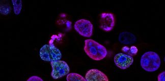 India faces steep blood cancer mortality rates with over 70,000 annual deaths cancer