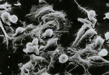 FDA approves first gene therapy for Metastatic Synovial Sarcoma FDA approves first gene therapy for Metastatic Synovial Sarcoma