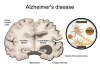 New discovery could offer significant answers on Alzheimer’s disease Alzheimer