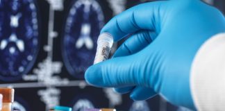 Alzheimer’s Diagnostic Blood Test Now Available in the UK Alzheimer