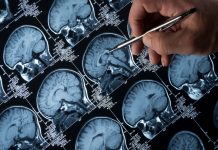 Epilepsy experts bat on new age treatment Epilepsy