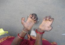 Leprosy day and public health — Promoting early diagnosis Leprosy