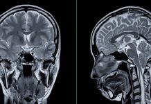 Alzheimer’s disease is a growing concern Alzheimer’s