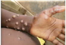 The fourth meeting of the IHR on the upsurge of mpox IHR