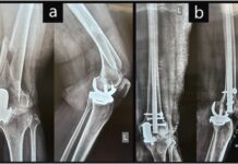 Not all need total knee replacement: Study knee