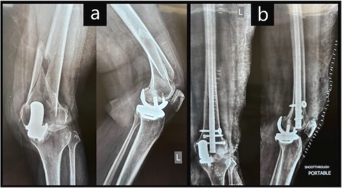 knee