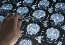 Combination therapies for Alzheimer’s disease Alzheimer's