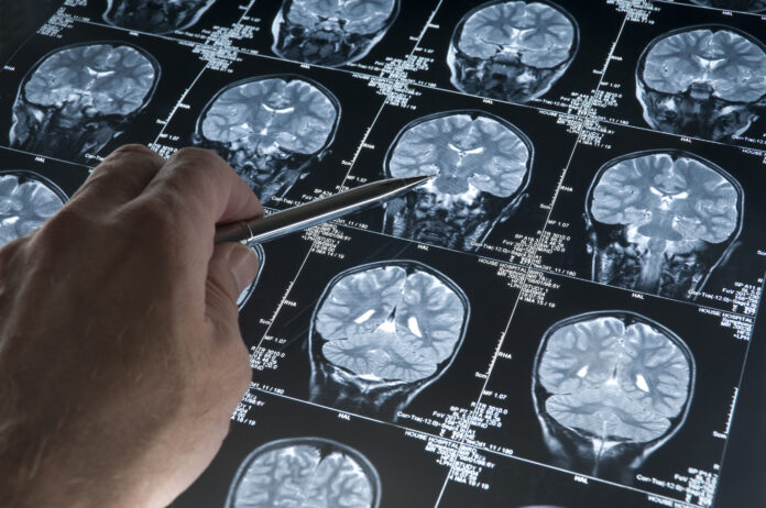 MRI Brain Scan of head and skull with hand pointing Alzheimer's
