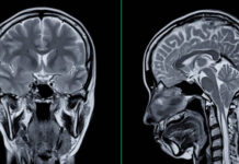 FDA clears new blood test for Alzheimer’s Alzheimer