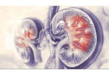 Aakash Healthcare marks 100 robotic urology surgeries Aakash