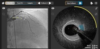 Philips agrees to acquire SpectraWAVE Inc Philips