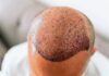 Top hair transplant surgeon sounds the alarm on India’s hair fall epidemic Hair
