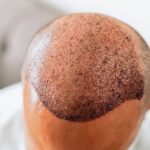 Top hair transplant surgeon sounds the alarm on India’s hair fall epidemic Hair