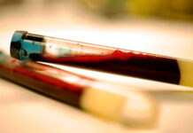 Early signs of Parkinson’s can be identified in the blood Parkinson’s