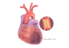 Coronary artery disease and drug-eluting stents Coronary