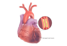 Coronary artery disease and drug-eluting stents Coronary