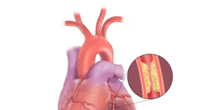 Coronary artery disease and drug-eluting stents Coronary