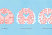 New research on Alzheimer treatment Alzheimer
