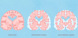 New research on Alzheimer treatment Alzheimer