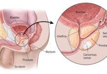 Microplastics discovered in prostate tumors prostate