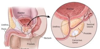 Microplastics discovered in prostate tumors prostate