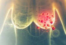 Standard radiotherapy treatment for breast cancer set to change Breast