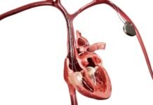 Philips launches new Bridge Plus Occlusion Balloon Philips