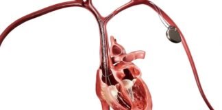 Philips launches new Bridge Plus Occlusion Balloon Philips