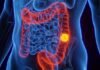 Pierre Fabre receives EC nod for colorectal cancer drug Pierre
