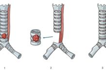 Advanced robotic surgery for windpipe cancer at Kasturba Manipal Kasturba