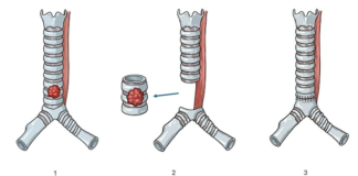 Advanced robotic surgery for windpipe cancer at Kasturba Manipal Kasturba