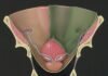 Cancer of the womb and early detection Cancer
